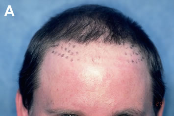 Art of Repair in Surgical Hair Restoration Pt I - Multiple rows of plugs created a low, broad hairline