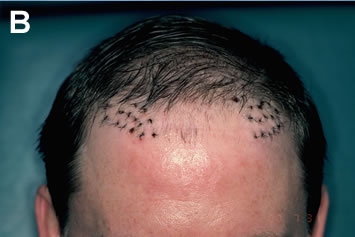 Art of Repair in Surgical Hair Restoration Pt I - Three sessions of graft excision and re-implantation were needed to remove and re-distribute the abnormal plugs