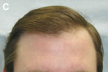 Art of Repair in Surgical Hair Restoration Pt I - Final result with the hairpiece gone and hair lightened