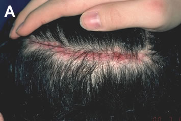 Art of Repair in Surgical Hair Restoration Pt II - Wide donor scar in a patient with Ehlers-Danlos Syndrome Type III