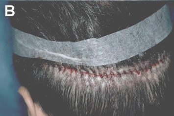 Art of Repair in Surgical Hair Restoration Pt II - Grafts harvested from an area of extensive scarring using the single-strip method