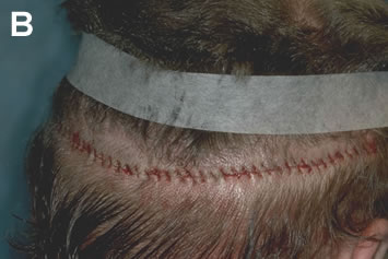 Art of Repair in Surgical Hair Restoration Pt II - Repair using a running stitch of absorbable sutures with smaller bites