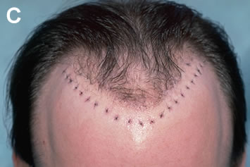 Art of Repair in Surgical Hair Restoration Pt II - Sutured sites after the removal (note the hair re-transplanted to the front edge of the old hairline)