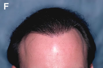Art of Repair in Surgical Hair Restoration Pt II - Final result after 3 sessions