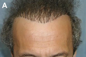 Art of Repair in Surgical Hair Restoration Pt II - Harsh pluggy hairline
