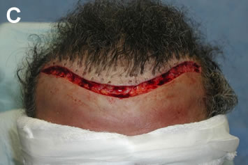 Art of Repair in Surgical Hair Restoration Pt II - Forty plugs removed in a single linear excision extending across entire hairline