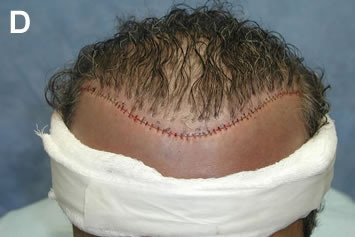 Art of Repair in Surgical Hair Restoration Pt II - Closure with five deep-dermal horizontal mattress sutures of 4-0 Vicryl and 1 running cutaneous suture using 5-0 Monocryl