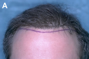 Art of Repair in Surgical Hair Restoration Pt II - Uniform, unnatural frontal hairline in a patient with excellent hair characteristics
