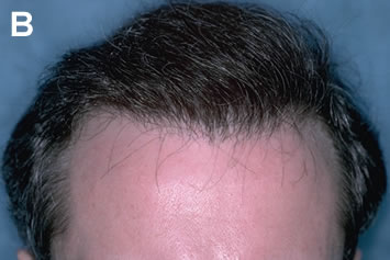 Art of Repair in Surgical Hair Restoration Pt II - Repair using two sessions of Follicular Unit Transplantation