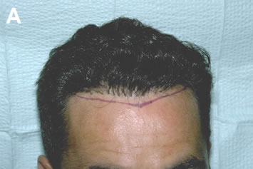 Art of Repair in Surgical Hair Restoration Pt II - Very pluggy frontal hairline from old punch-graft technique