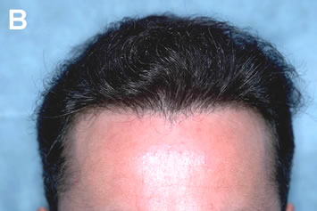 Art of Repair in Surgical Hair Restoration Pt II - A slight Widow's Peak was created to break up the straight-line appearance of the hairline and to camouflage the plugs