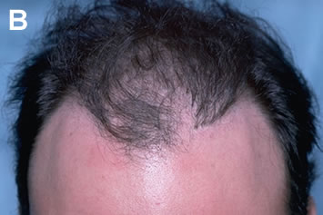 Art of Repair in Surgical Hair Restoration Pt II - Front view of patient previously shown in Figure 8