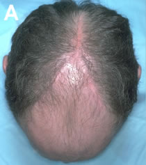 Art of Repair in Surgical Hair Restoration Pt II - Patient with a Norwood class 6 balding pattern who had several 'Y-Shaped' scalp reductions to decrease the size of his bald crown