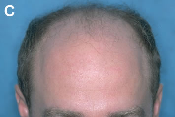 Art of Repair in Surgical Hair Restoration Pt II - Frontal view before repair
