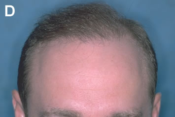 Art of Repair in Surgical Hair Restoration Pt II - Frontal view showing the significant change in his appearance after one hair transplant repair session