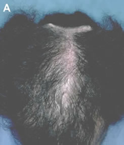 Art of Repair in Surgical Hair Restoration Pt II - Complications of a poorly planned scalp reduction that produced a wide scar and a 'Dog Ear' puckering of the scalp