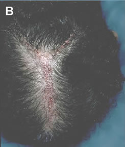 Art of Repair in Surgical Hair Restoration Pt II - The elevated dog-ear section was excised so that the area lies flat