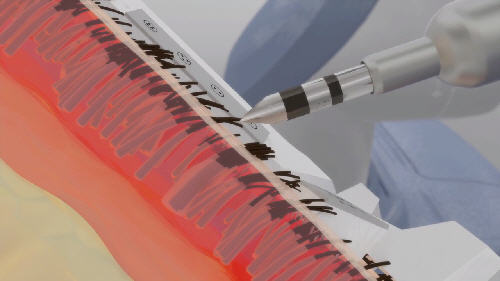 Bernstein Medical - Video Animation of a ARTAS Robotic 2-Step Follicular Dissection