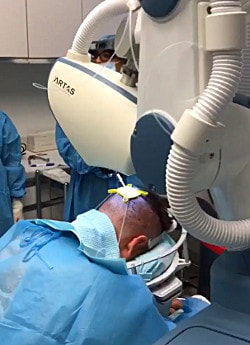 First ever case with ARTAS 9x at Bernstein Medical