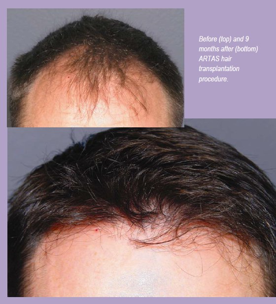 Before & 9 Months After FUE with ARTAS Robotic System