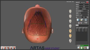 Figure 1. ARTAS Hair Studio™ software showing the hair transplant design