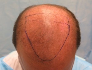 Figure 3. Before with marking for the procedure