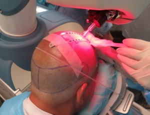 Robotic recipient site creation in hair transplantation 