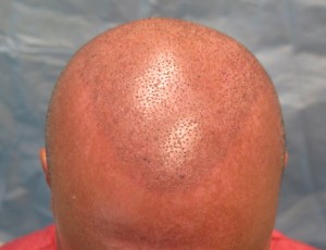 Recipient sites with grafts - 2-days post-op