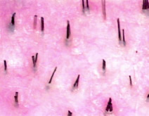 Avoiding Pitfalls in Hair Transplantation - Low density (1.3 hairs/mm2) and extensive miniaturization