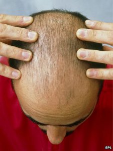 Crown Balding and Heart Disease Linked in British Medical Journal Study