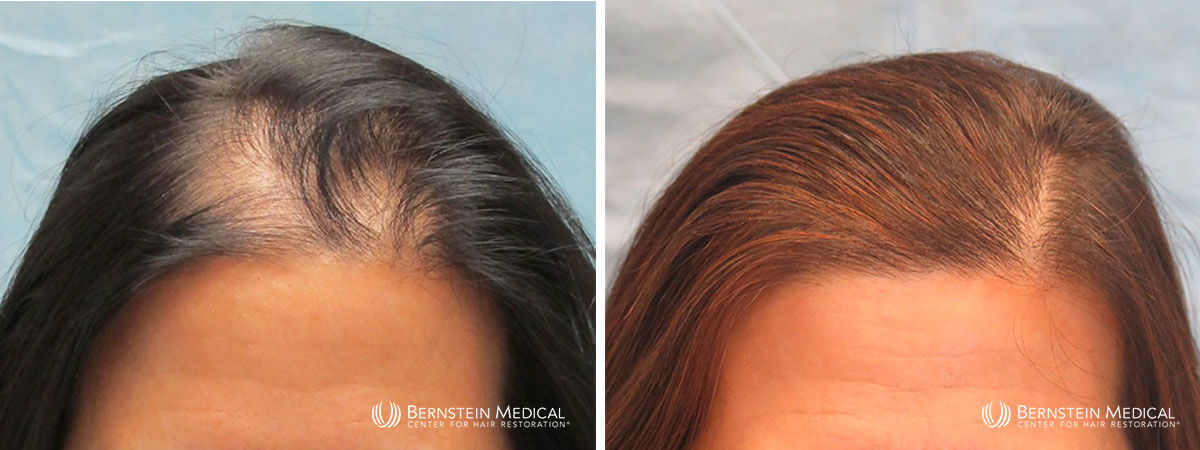 Bernstein Medical - Patient LCB Before and After Hair Transplant Photo 
