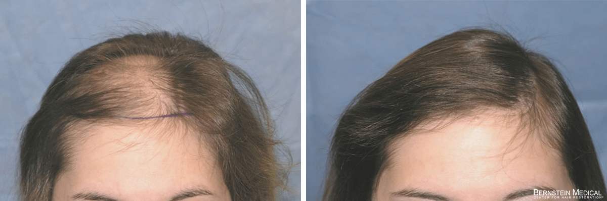 Bernstein Medical - Patient QLR Before and After Hair Transplant Photo