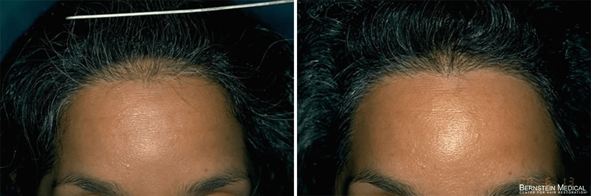Bernstein Medical - Patient KAR Before and After Hair Transplant Photo 