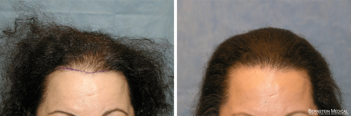 Bernstein Medical - Patient KJO Before and After Hair Transplant Photo 