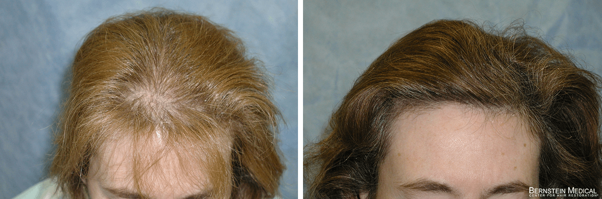 Bernstein Medical - Patient LCK Before and After Hair Transplant Photo 