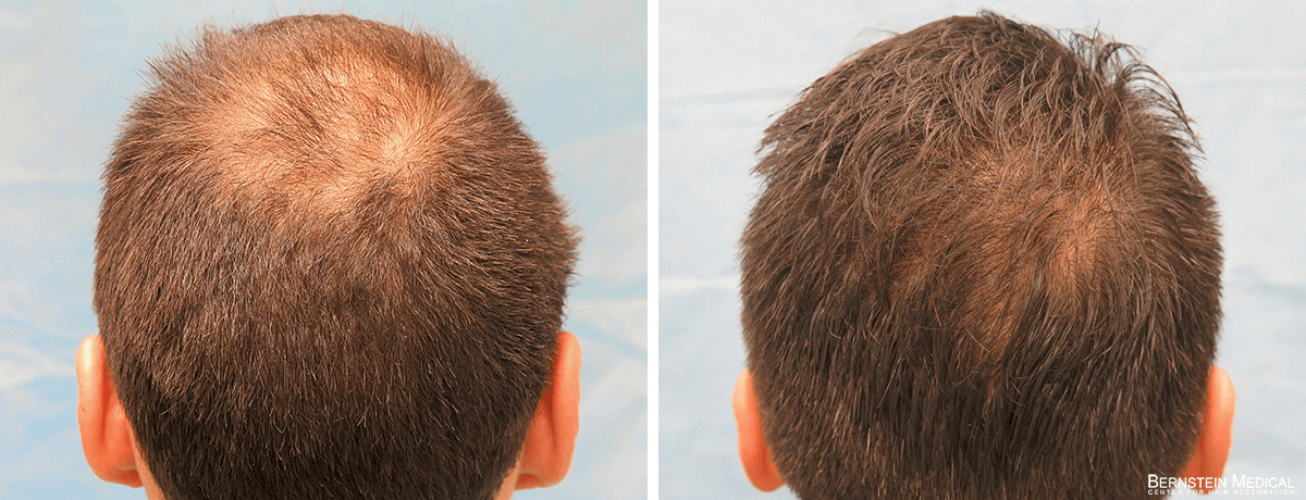Bernstein Medical - Patient AVQ Before and After Hair Transplant Photo 