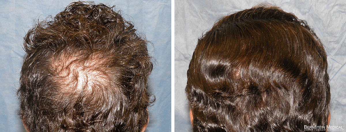 Bernstein Medical - Patient LAA Before and After Hair Transplant Photo 