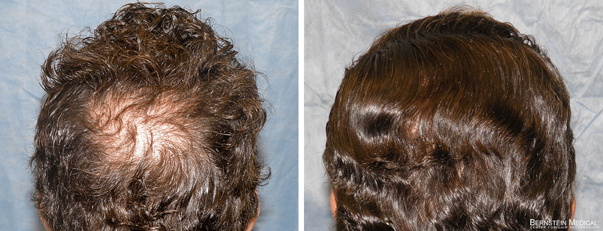 Bernstein Medical - LAA: Candidate for crown hair transplant to address hair loss at the vertex of the scalp. Before and After Hair Transplant Photo
