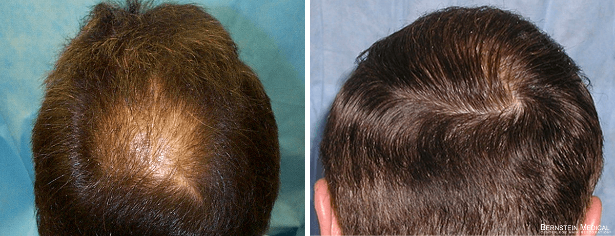 Bernstein Medical - Patient LCI Before and After Hair Transplant Photo 