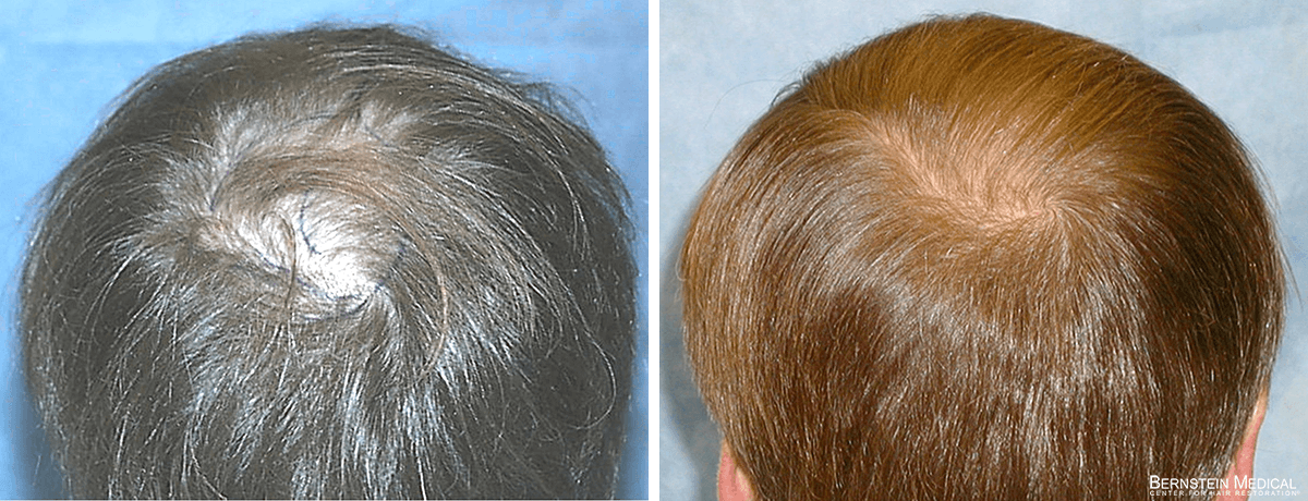 Bernstein Medical - Patient ODR Before and After Hair Transplant Photo 