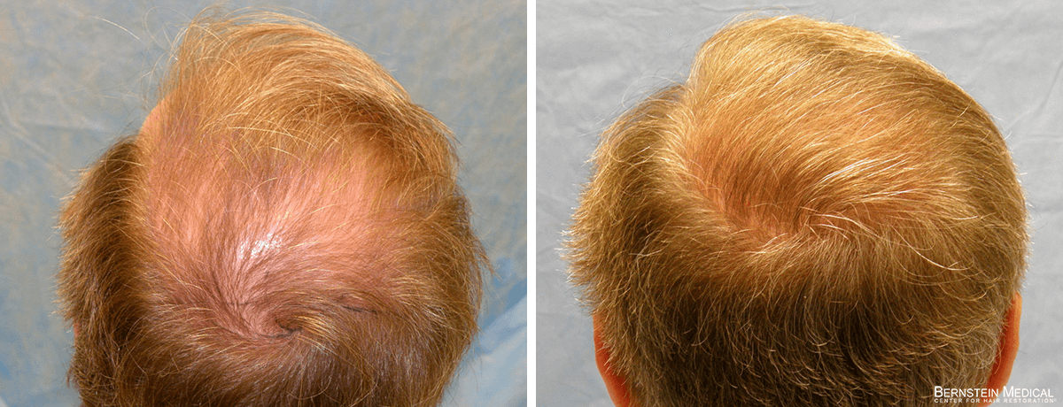 Bernstein Medical - Patient RKS Before and After Hair Transplant Photo