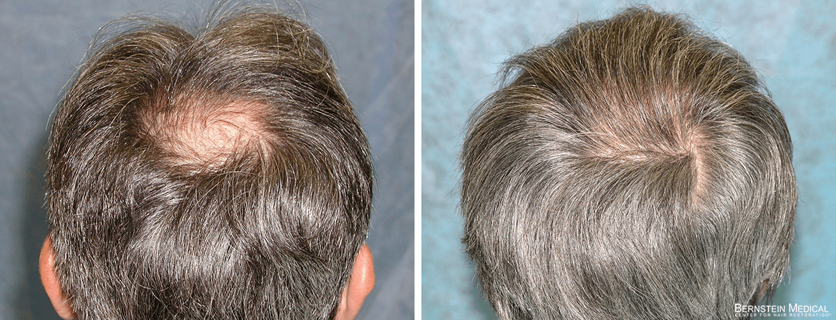 Bernstein Medical - Patient SPI Before and After Hair Transplant Photo 