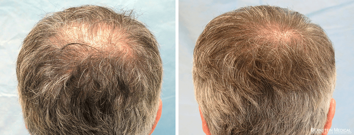 Bernstein Medical - Patient ZIV Before and After Hair Transplant Photo 