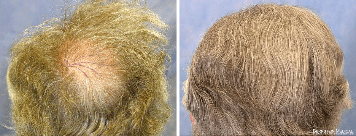 Bernstein Medical - Patient ZLA Before and After Hair Transplant Photo
