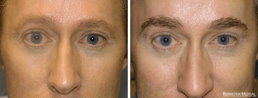 Bernstein Medical - Patient CAB Before and After Hair Transplant Photo