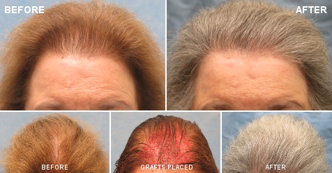 Hair Loss in Women: Diagnosis Female Thinning | Bernstein Medical