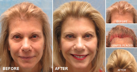 Female Hair Transplant Photos | Bernstein Medical