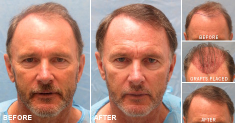 Hair Transplant Before After - Patient GMZ