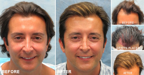 Before and after hair transplant Step-by-Step Situation - Desmoderm