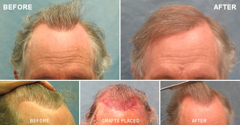 Fix Bad Hair Transplant | Plug Repair | Bernstein Medical